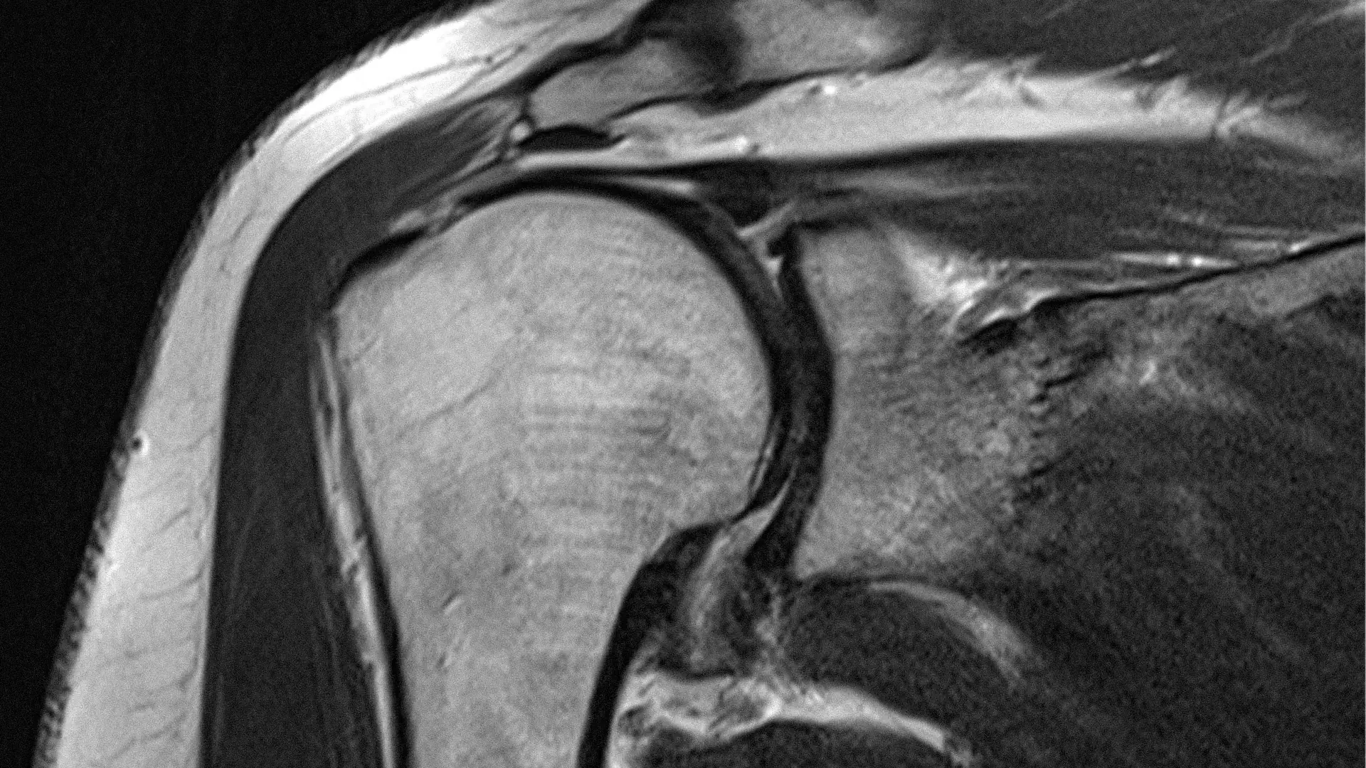 The 10-Year Rotator Cuff Study Surgeons Don't Talk About Enough
