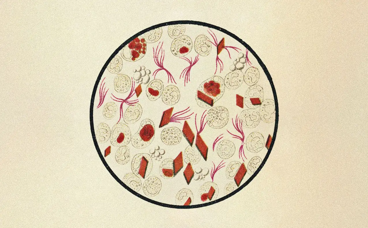 Microscope view of fibrotic tissue